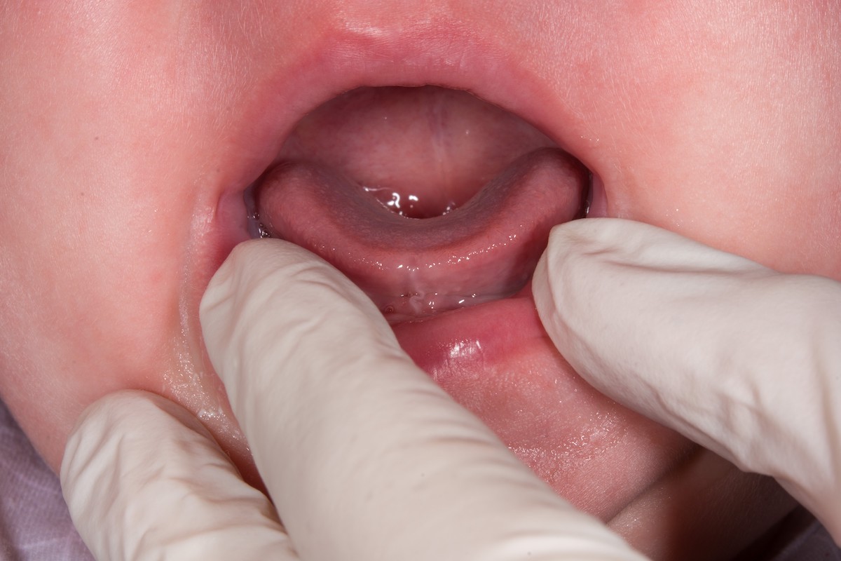 Treatment Of Infant Tongue Tie Lingual Frenectomy Hervey Bay