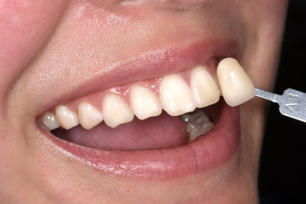 A close-up showing an A3 shade tab held against the patient's central incisors to determine the colour of the teeth.